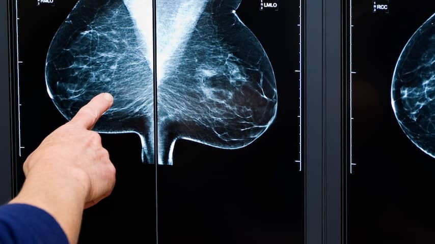 Kunstmatige intelligentie detecteert borstkanker