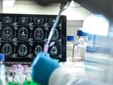 Resultaten nieuw alzheimermedicijn 'historisch', wel zorgen over bijwerkingen