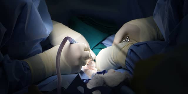Operatie scheiding Siamese tweeling