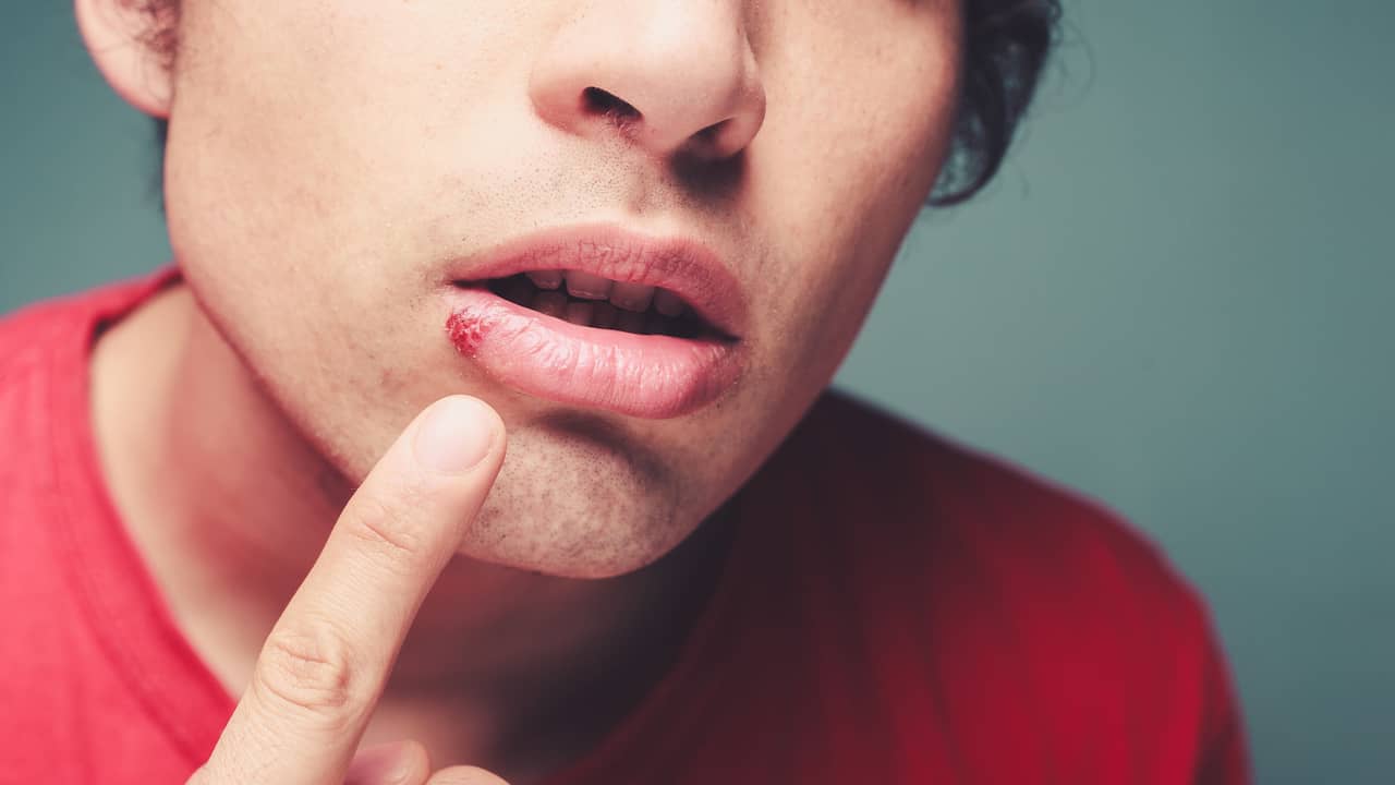 герпес на губах: к какому врачу обращаться
