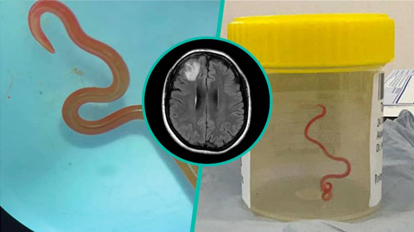 Artsen vinden worm die voorkomt bij pythons in hersenen Australische vrouw