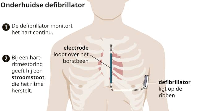 De onderhuidse defibrillator, zoals die bij Ajacied Daley Blind werkt. Het is niet helemaal duidelijk of Christian Eriksen eenzelfde soort ICD krijgt.