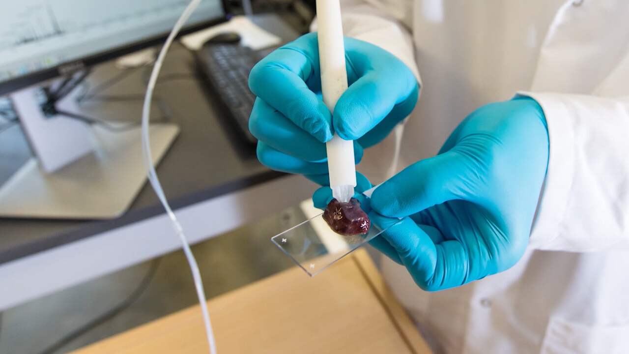 Kankerweefsel wordt dankzij nieuwe uitvinding snel opgespoord