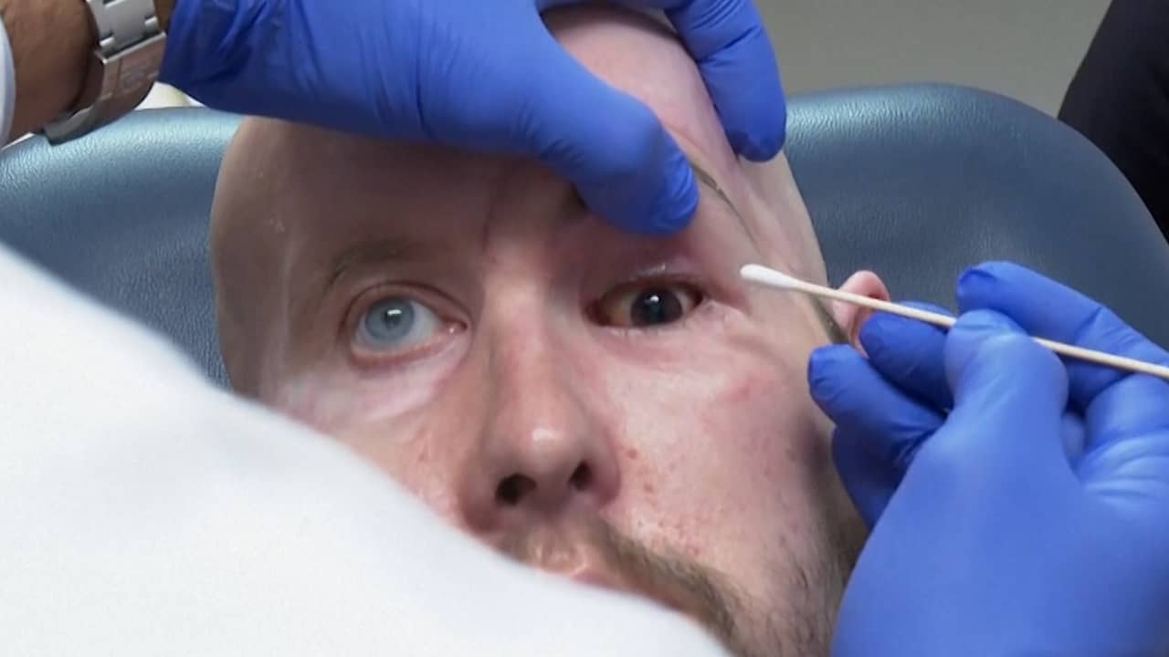Beeld uit video: Amerikaan krijgt 's werelds eerste volledige oogtransplantatie