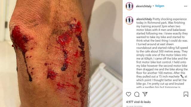 Alexander Richardson postte op Instagram een foto van een deel van zijn verwondingen.