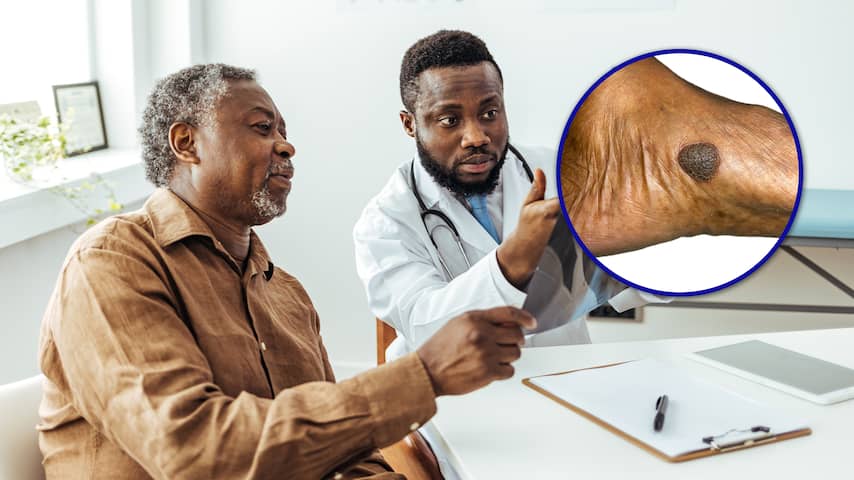 Meer bekend over melanomen: huidkankervorm is dodelijker voor zwarte mannen