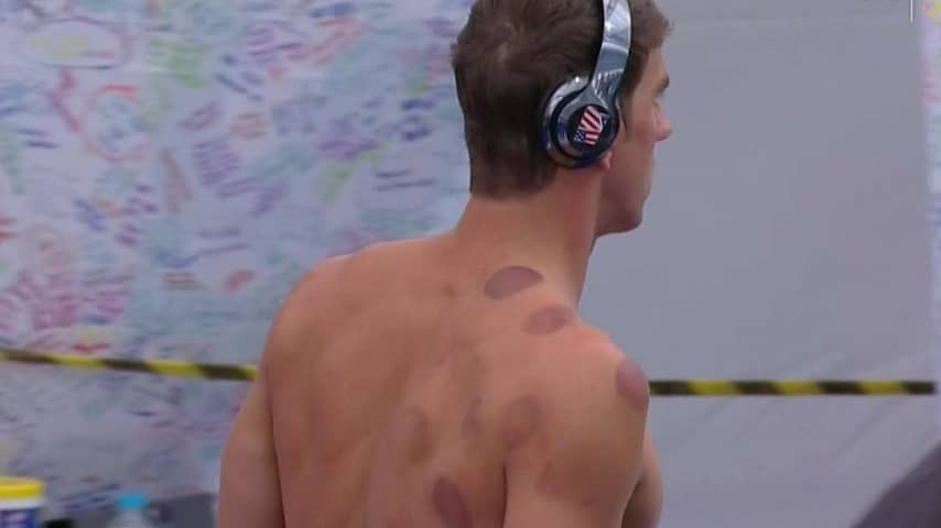 Michael Phelps, Cupping