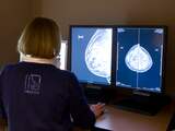 'Ex-patiënten borstkanker onnodig vaak naar ziekenhuis voor controle'