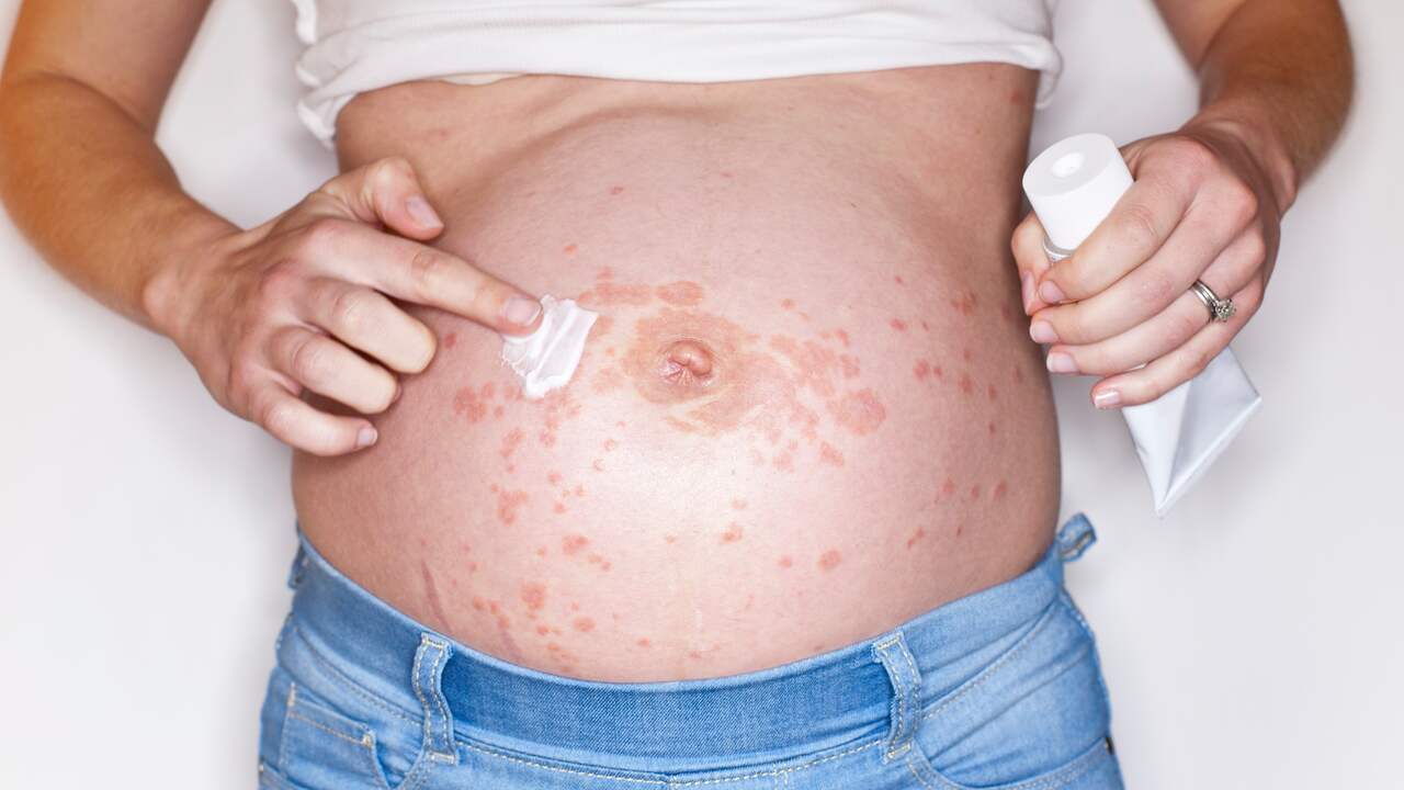 Zwanger en helse jeuk: zo herken je zwangerschapscholestase | Kind & Gezin  | NU.nl