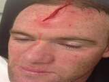 Rooney geeft foto's hoofdwond vrij