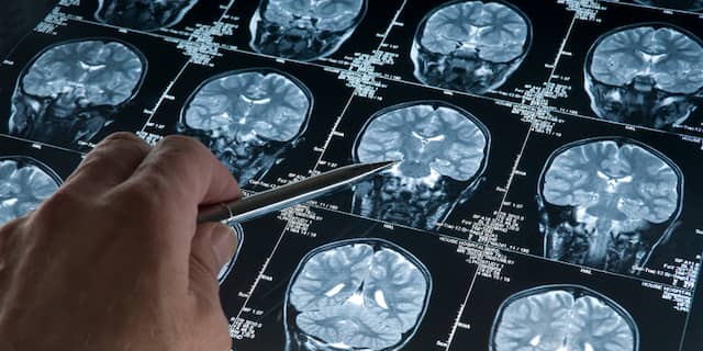 alzheimer