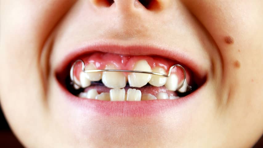 beugel tanden tandarts orthodontist