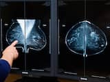 'Mammogram redt nauwelijks levens'