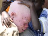 Tanzaniaanse albino's willen executie van heksen