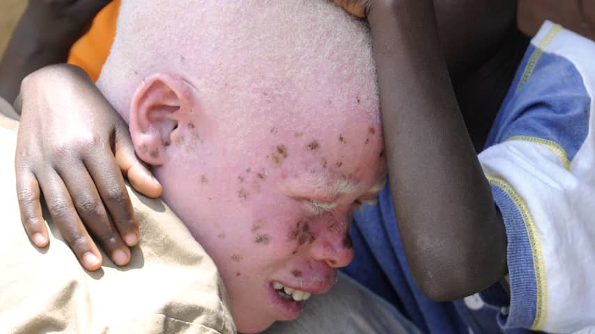 Malawi gaat ontvoerders albino's aanpakken