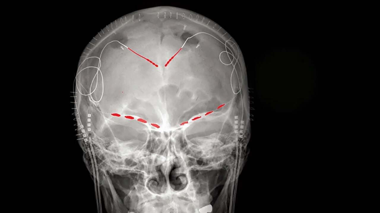 Scientists see brain signals for chronic pain for the first time |  Sciences