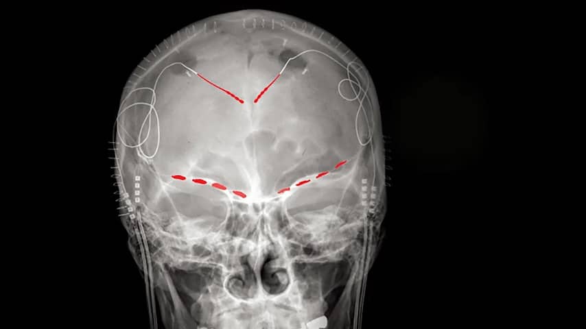 Wetenschappers zien voor het eerst hersensignalen van chronische pijn