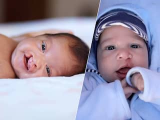 300 baby's per jaar worden geboren met schisis