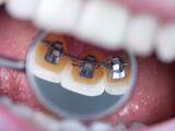 'Orthodontisten geven nog steeds te weinig informatie'
