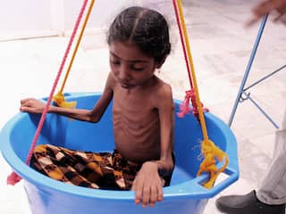 'Ruim 80.000 kinderen Jemen gestorven aan hongerdood'