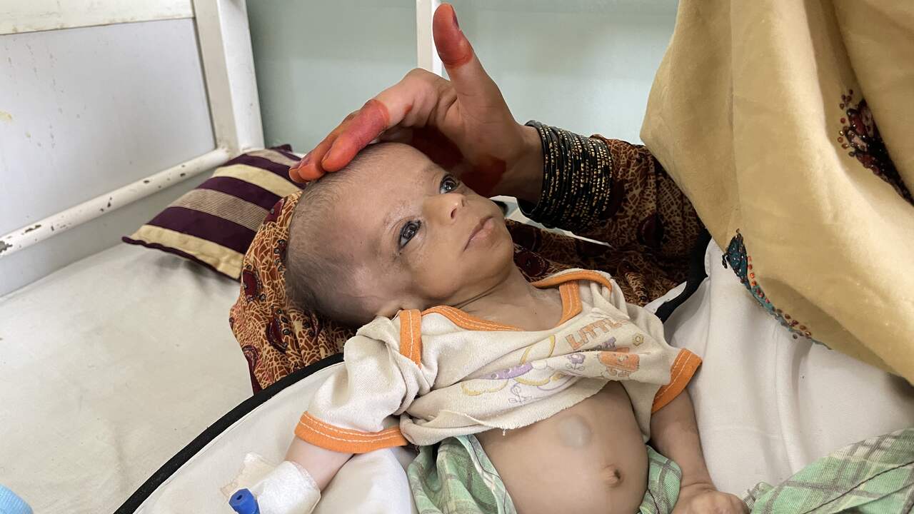 Een zwaar ondervoed kind krijgt eind oktober 2021 medische hulp in het Mir Veys-ziekenhuis in de Afghaanse stad Kandahar.